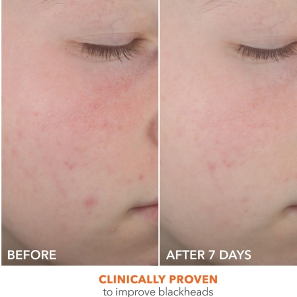 NIB DR.DENNIS GROSS ALPHA BETA 2% ON THE SPOT ELIMINATOR ACNE TREATMENT GEL - Picture 10 of 16